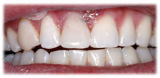 CASE #7: Emergency Treatment - Fractured Tooth (after)