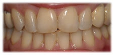 CASE #8: Cosmetic Dentistry - Teeth Whitening (before)