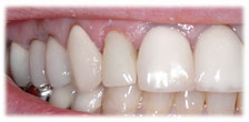 CASE #9: Emergency Treatment - Fractured Tooth (after)