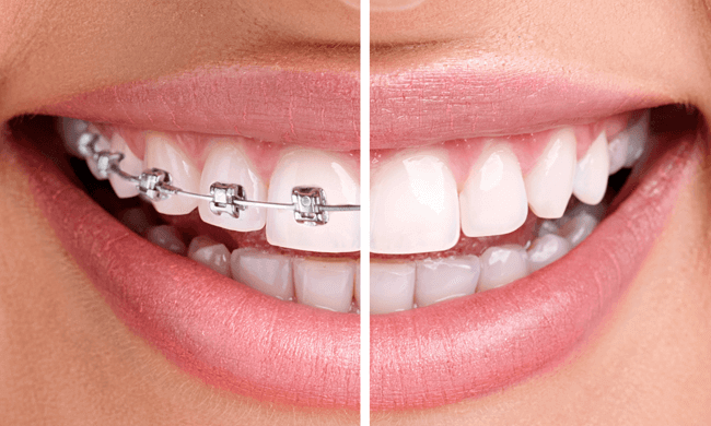 Orthodontics / Braces