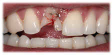 Fractured Tooth Before
