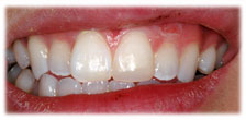 Broken/Chipped Teeth After