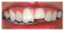 Broken/Chipped Teeth Before