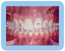 Placement of Brackets