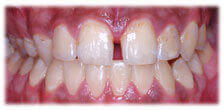 Cleaning - Teeth Whitening after
